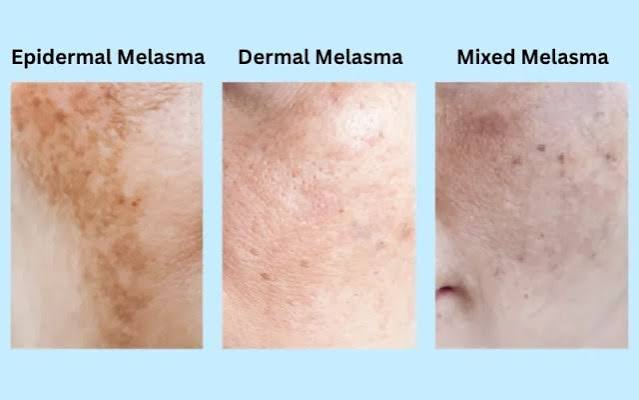 Apa Itu Melasma dan Bagaimana Rawatannya?