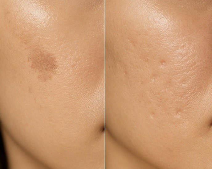 What Is PIH? Acne Marks vs Scars, and What to Check Before Treatment