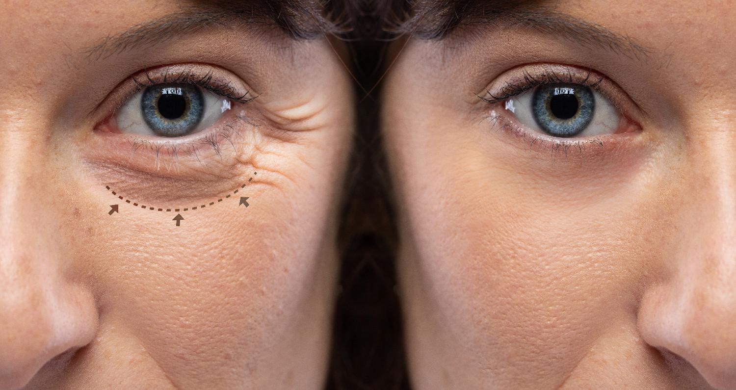 Can Profhilo Improve the Under-Eye Area?