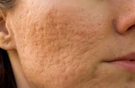 Acne Scars treatment concern