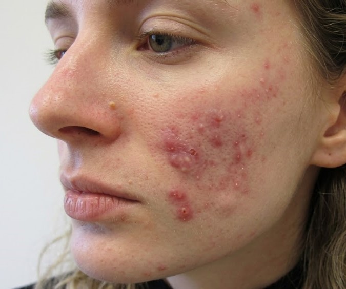 Acne treatment concern