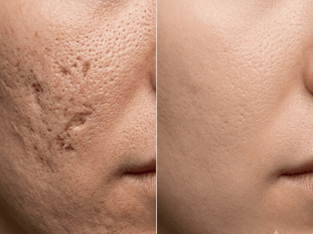 Fractional CO2 treatment at Klinik Dr Diana