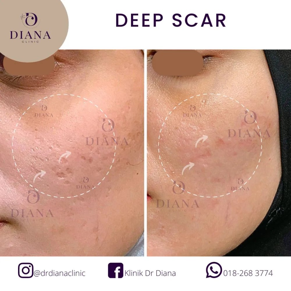 Before and after acne scar treatment result