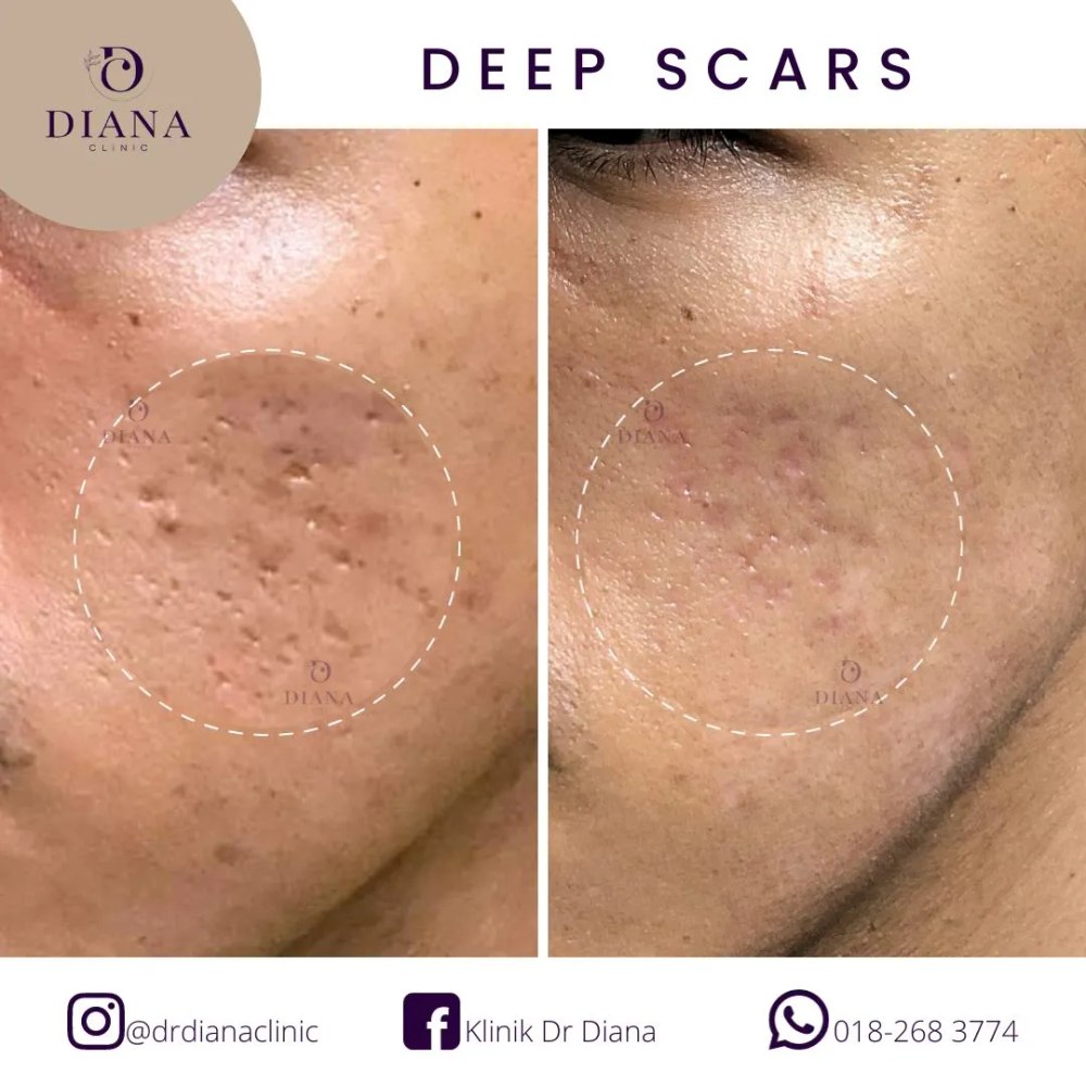 Before and after acne scar treatment showing texture improvement
