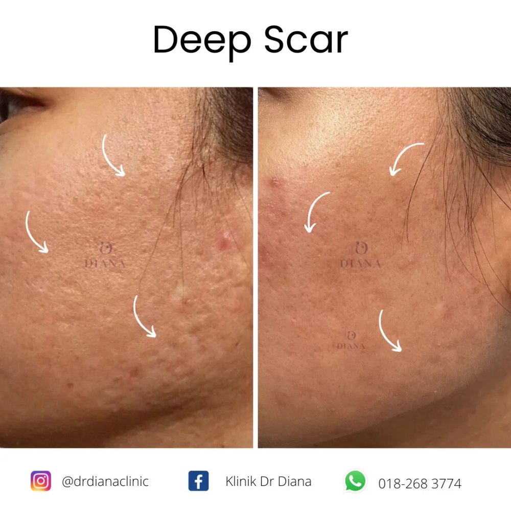 Before and after acne scar treatment showing rolling scar improvement