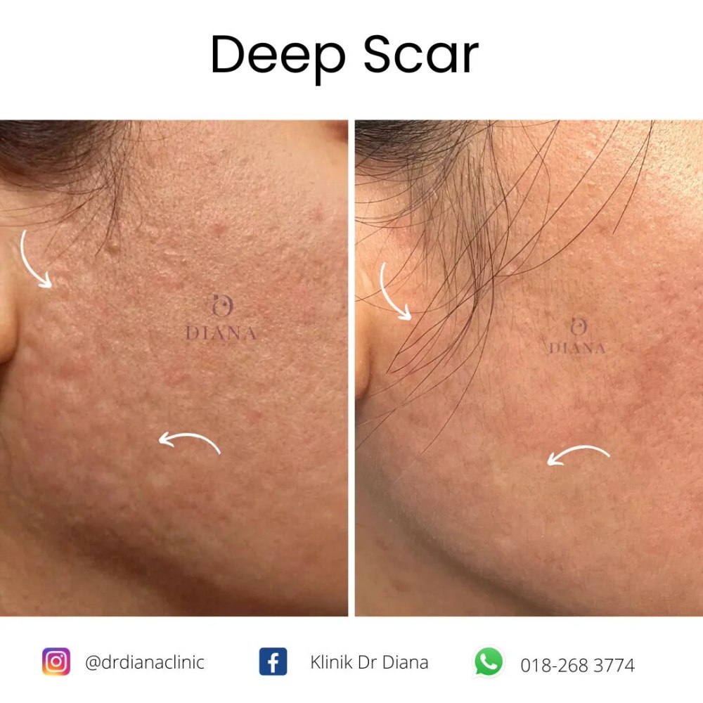 Before and after acne scar treatment at Klinik Dr Diana Bangi