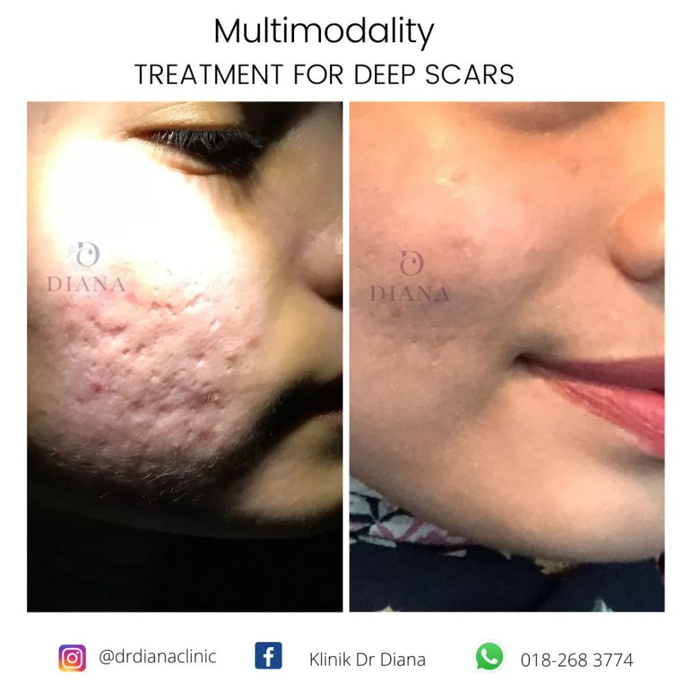Before and after acne scar treatment showing skin resurfacing result