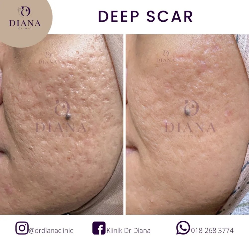 Before and after acne scar treatment showing boxcar scar improvement