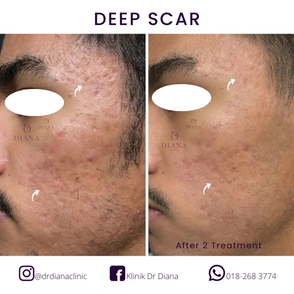Before and after acne scar treatment showing overall scar reduction