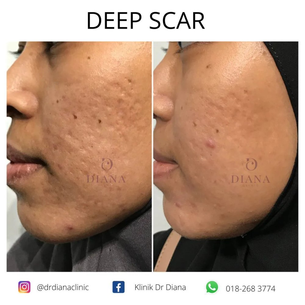 Before and after acne scar treatment showing combined therapy result