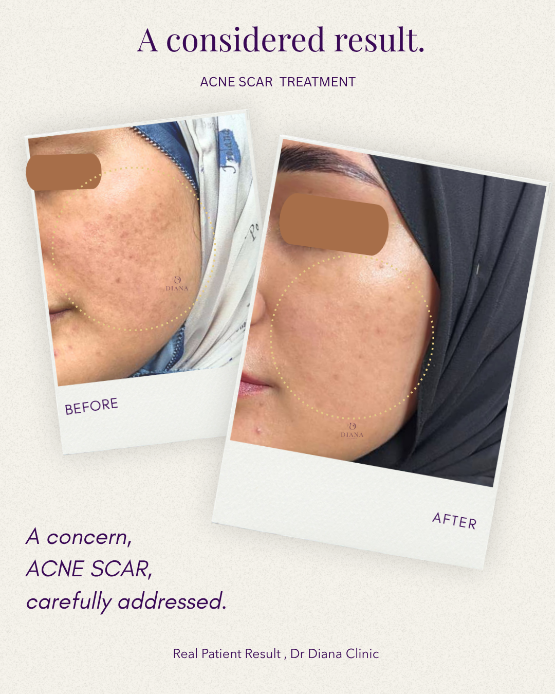 Before and after acne scar treatment result at Klinik Dr Diana