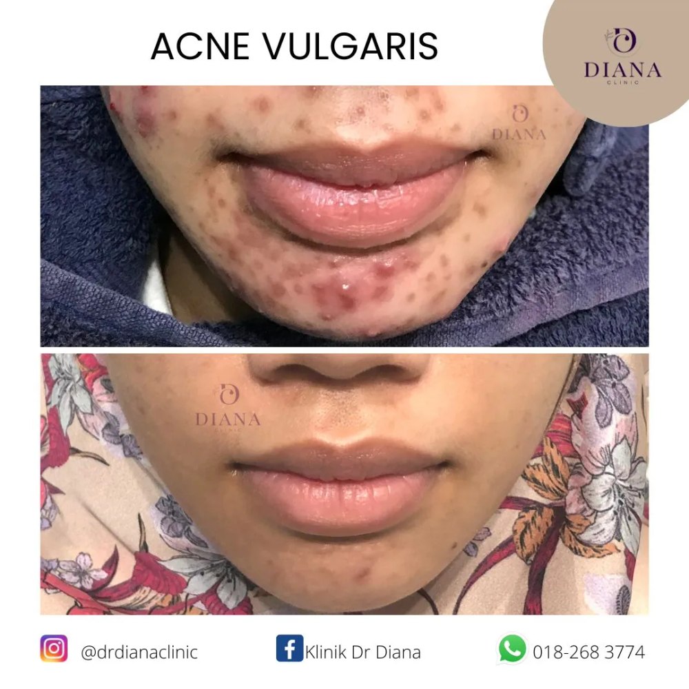 Before and after acne treatment result