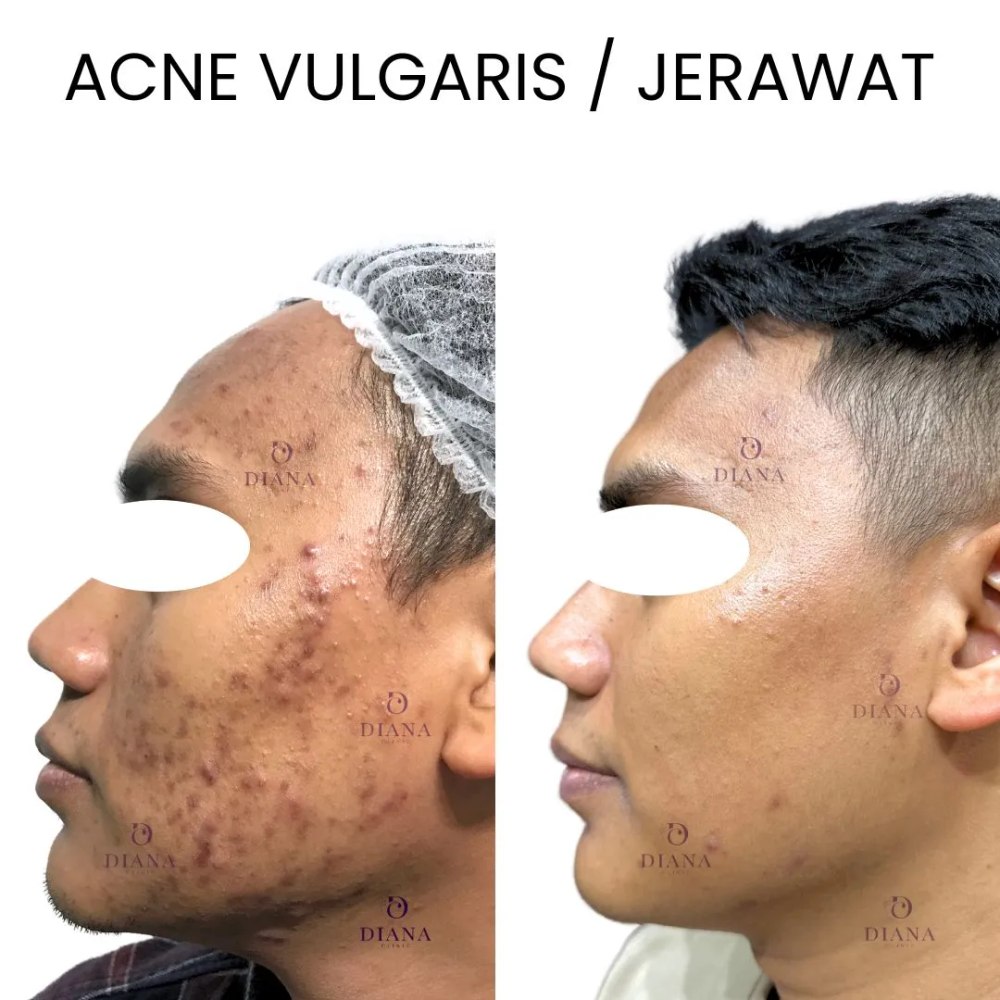 Before and after acne treatment result showing skin clearance