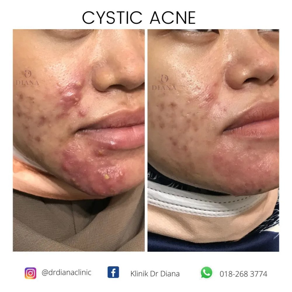 Before and after acne treatment showing improvement