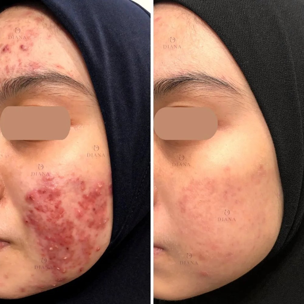 Before and after acne treatment result at Klinik Dr Diana Bangi