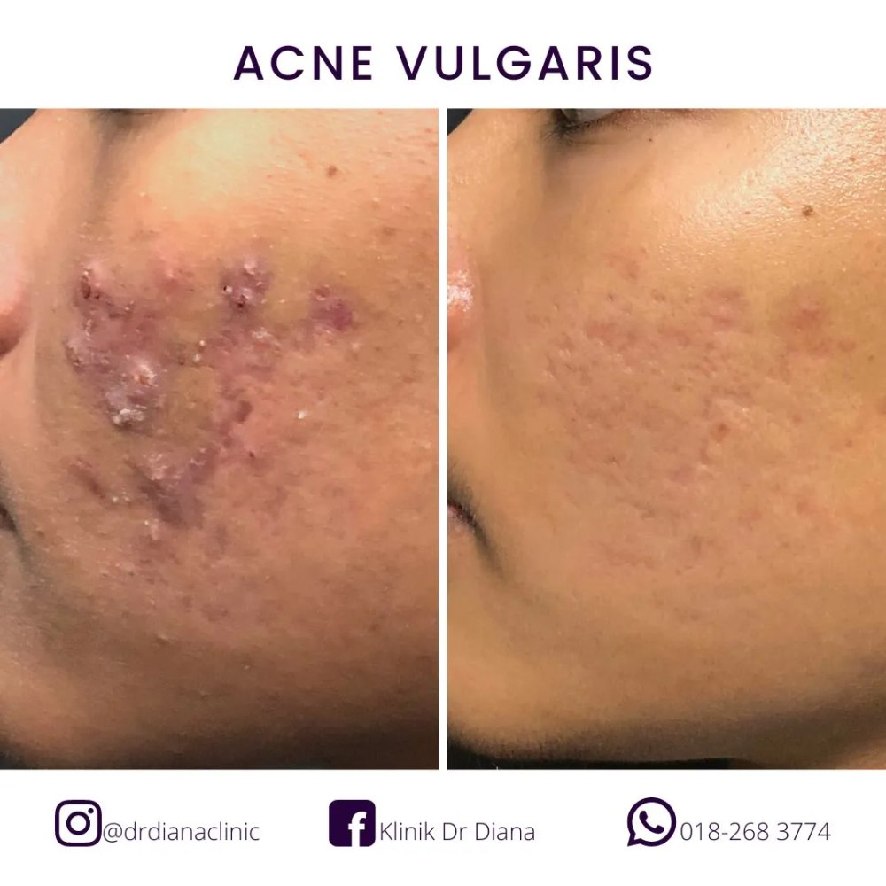 Before and after acne treatment result showing overall improvement