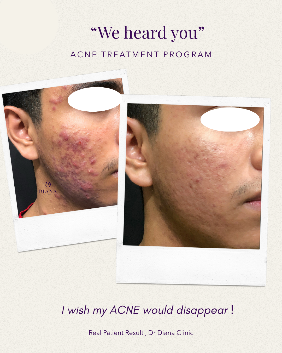 Before and after severe acne treatment result at Klinik Dr Diana