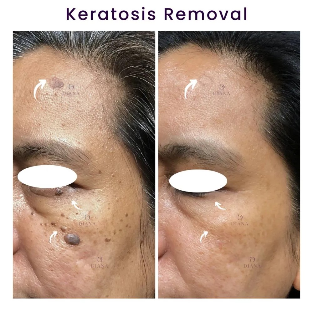Before and after keratosis removal result