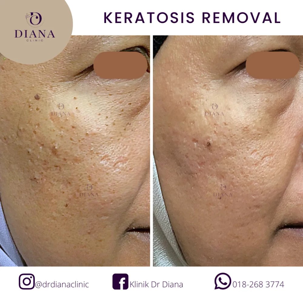 Before and after keratosis removal treatment showing skin clearance