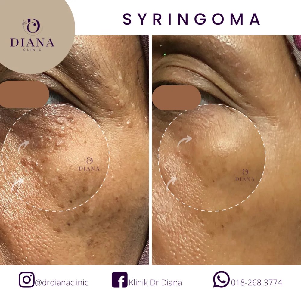 Before and after syringoma removal treatment at Klinik Dr Diana