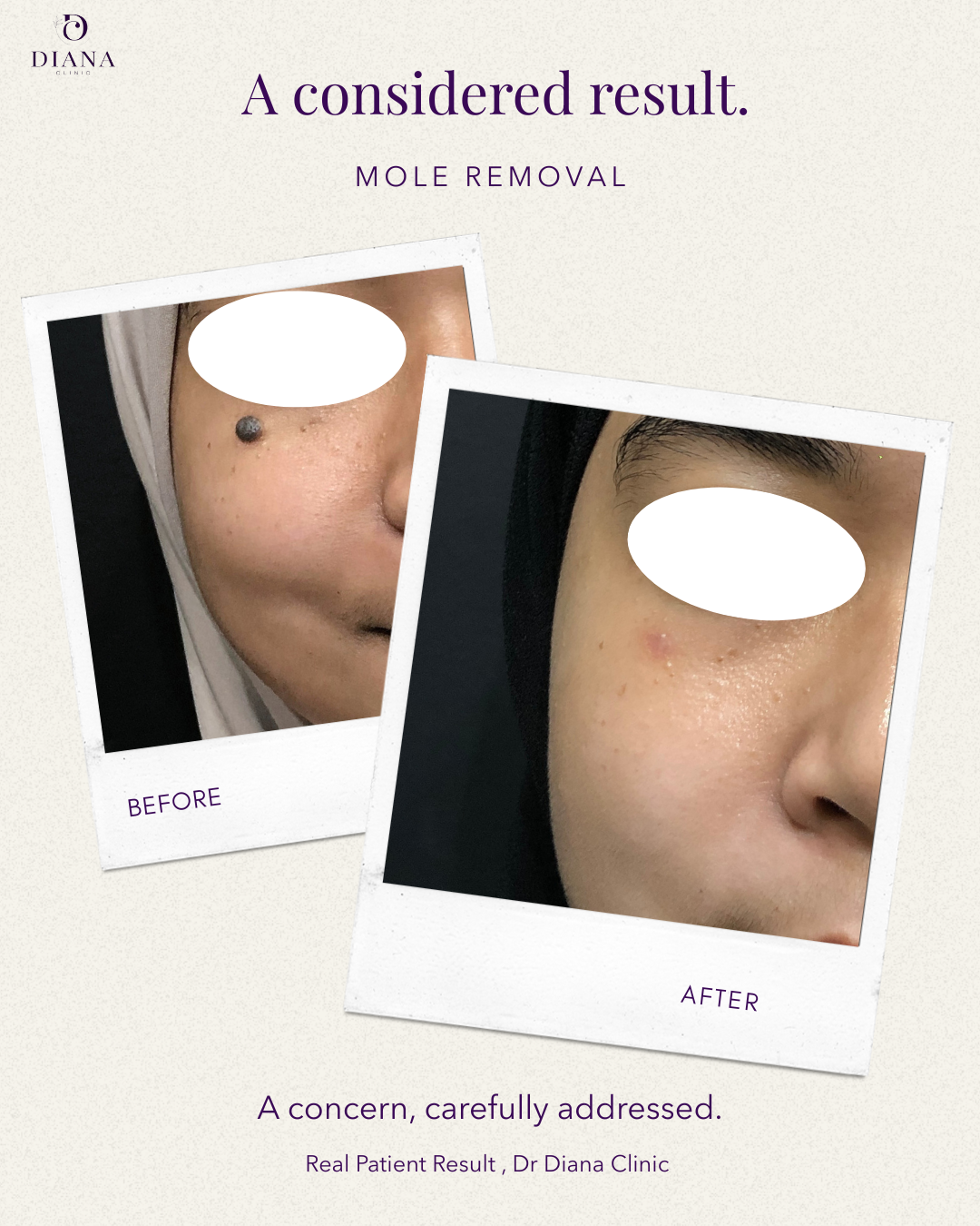 Before and after mole removal treatment at Klinik Dr Diana