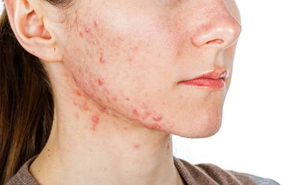 Hormonal acne along the jawline and chin area