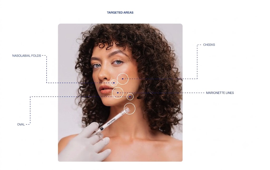 Novuma biostimulator targeted facial areas — cheeks, nasolabial folds, marionette lines and jawline