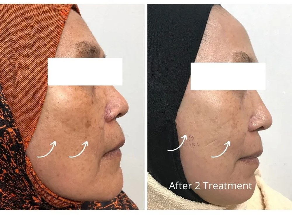 Before and after pigmentation treatment showing melasma improvement