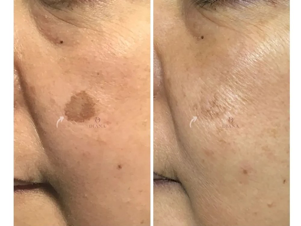 Before and after pigmentation treatment showing solar lentigo improvement