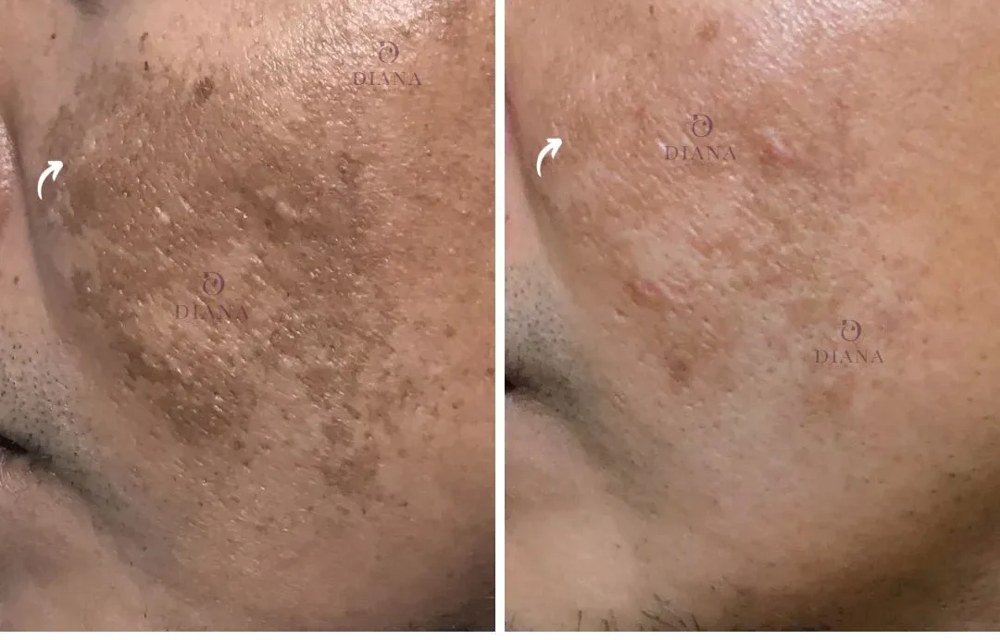 Before and after pigmentation treatment showing pigmentation and skin texture improvement