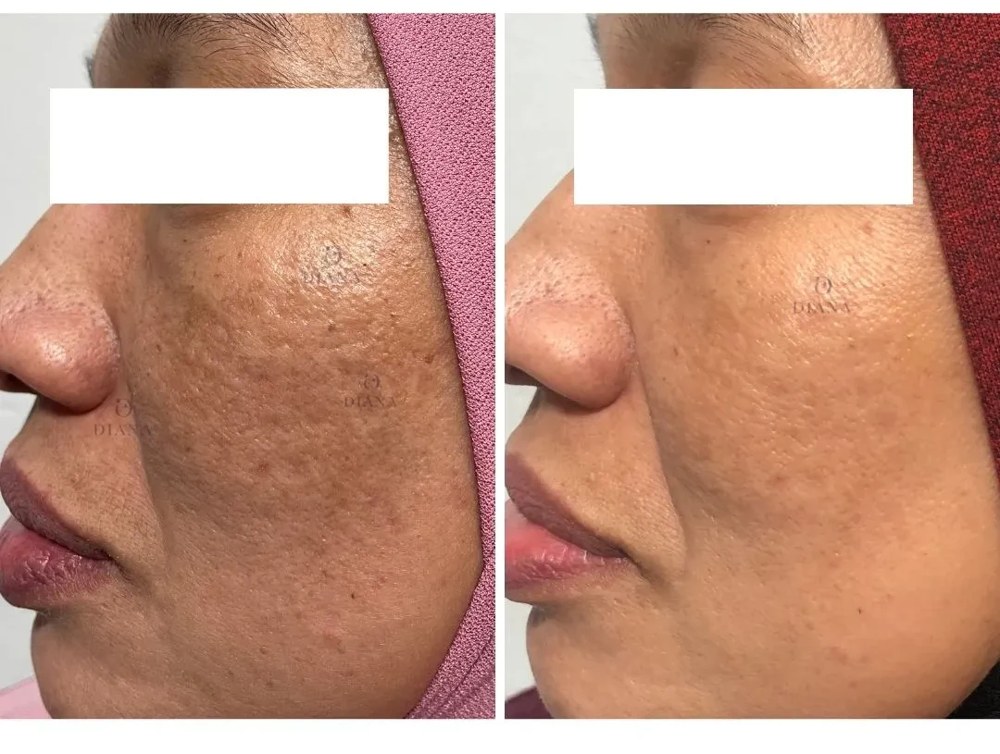 Before and after pigmentation treatment showing melasma improvement