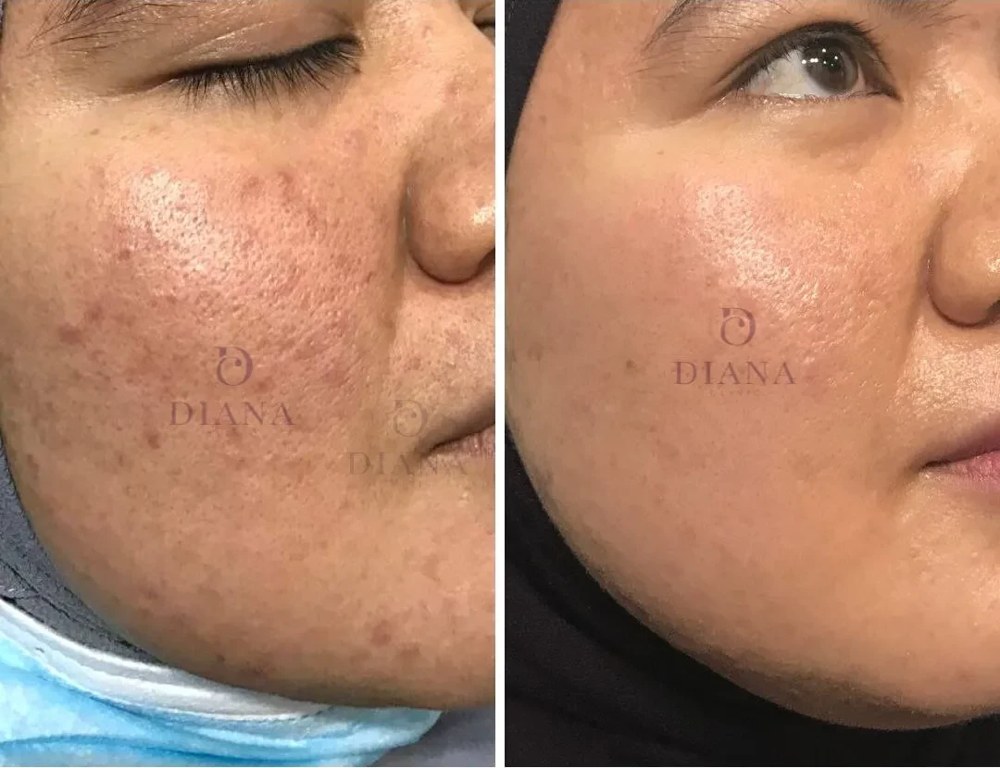 Before and after pigmentation treatment showing large pore and PIH improvement