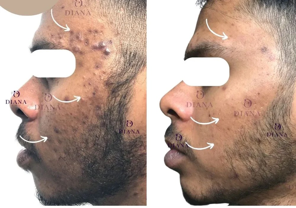 Before and after pigmentation treatment showing post-acne dark mark improvement