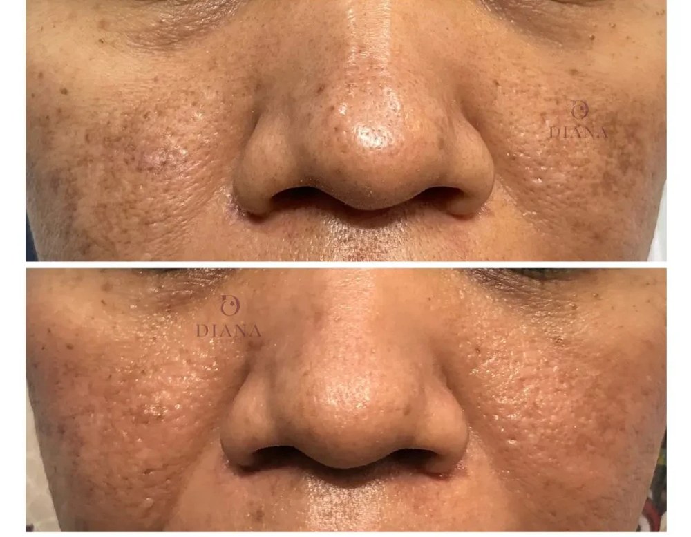Before and after pigmentation treatment showing aging-related pigmentation improvement