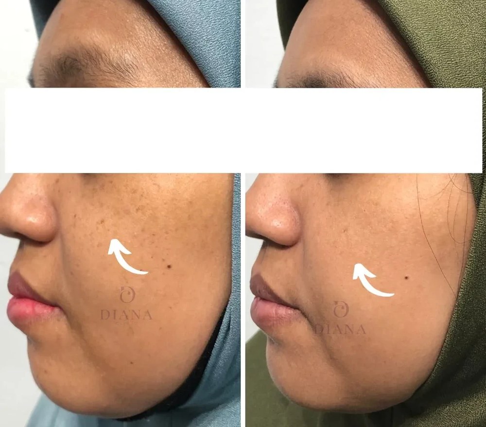 Before and after pigmentation treatment showing brightening and pigmentation improvement