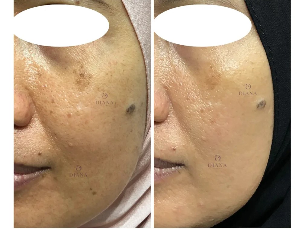Before and after pigmentation treatment showing pigmentation improvement
