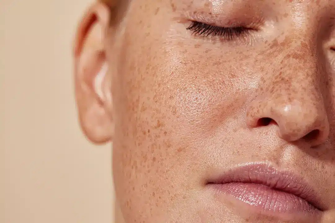 Close-up of freckles across the cheeks and nose