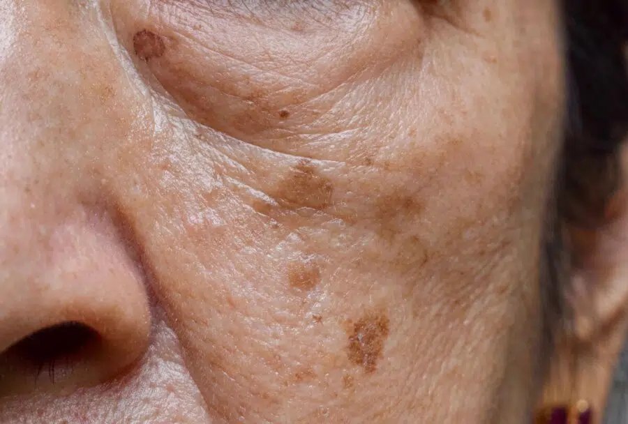 Close-up of a solar lentigo (sun spot) on the cheek