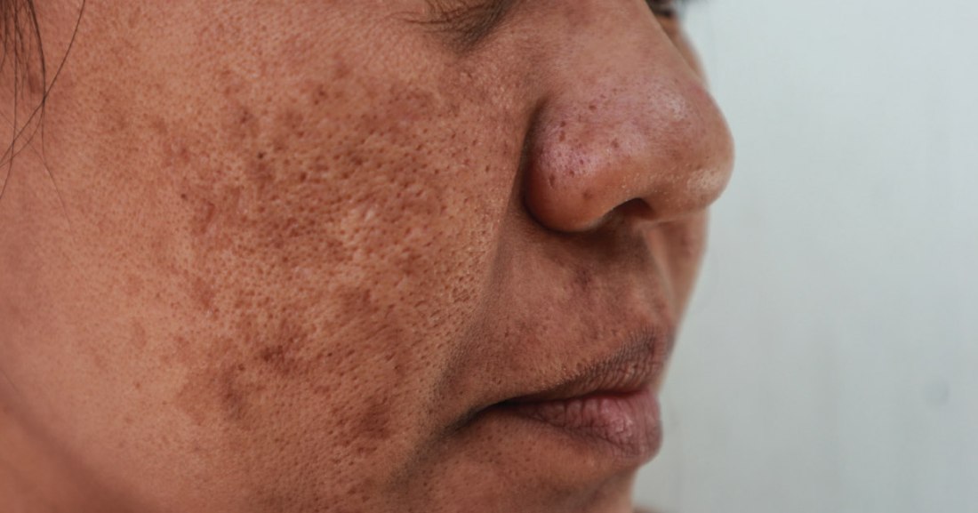 Close-up of melasma pigmentation patches on the cheek