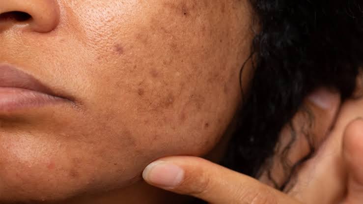 Close-up of post-inflammatory hyperpigmentation (PIH) on the cheek from past acne